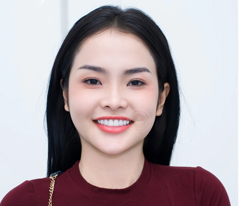 Bọc răng sứ giá bao nhiêu 1 cái? Bảng giá & Thông tin cần biết